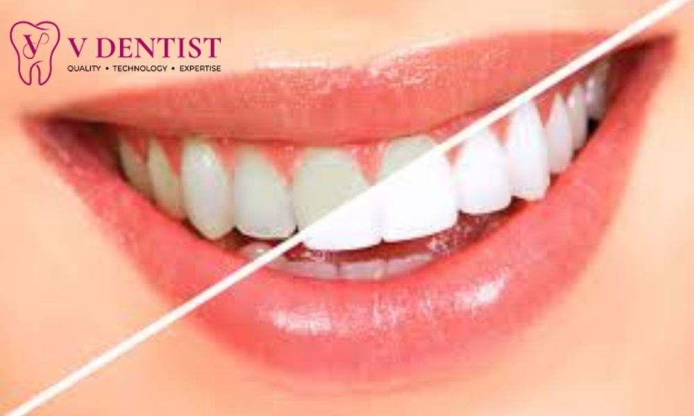 Dentist Whitening Cost
