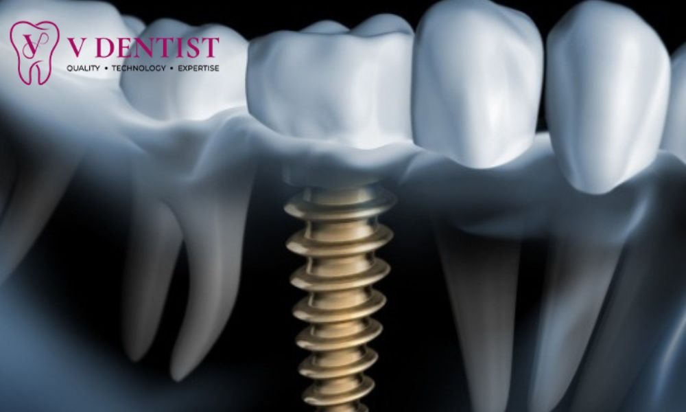 Dental Implant Cost in kolathur