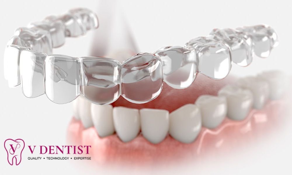 Invisible Braces and Invisalign in Kolathur, Chennai – Smile Confidently with V Dentist